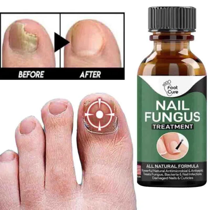 Fast Nail Fungal Treatments Nail Repair Essences Serum Care Treatments Foot Nail Fungus Removal Gel image 3