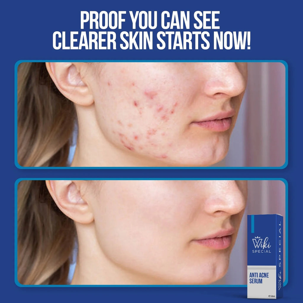 Wiki Special Anti Acne Serum – 30ml | Clears Acne, Soothes Skin &amp; Fights Blemishes image 1