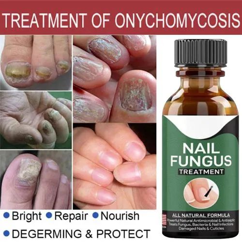 Fast Nail Fungal Treatments Nail Repair Essences Serum Care Treatments Foot Nail Fungus Removal Gel image 0