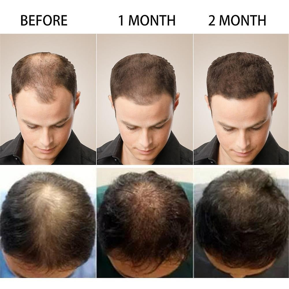 Anti Hair Loss Serum 2 in 1 Natural Hair Fall Serum Ginger and Tocopherol Hair Growth Essence Oil Hair Care Serum | Hair Loss Treatment for Men &amp; Women | image 3