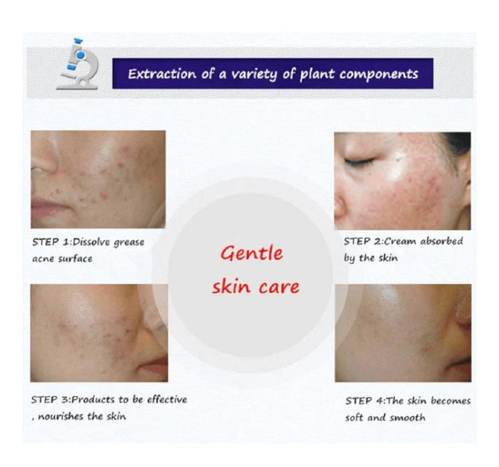 BIOAQUA Anti Acne Cleanser For Removal Of Acne - 100ml image 0