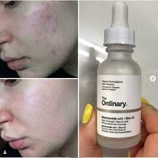 The Ordinary Niacinamide 10% + Zinc 1 % - 30ml image 3